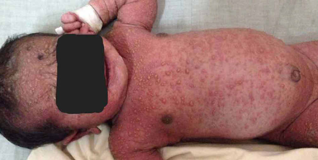 Chickenpox vaccination