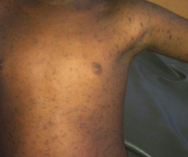 Measles medical case