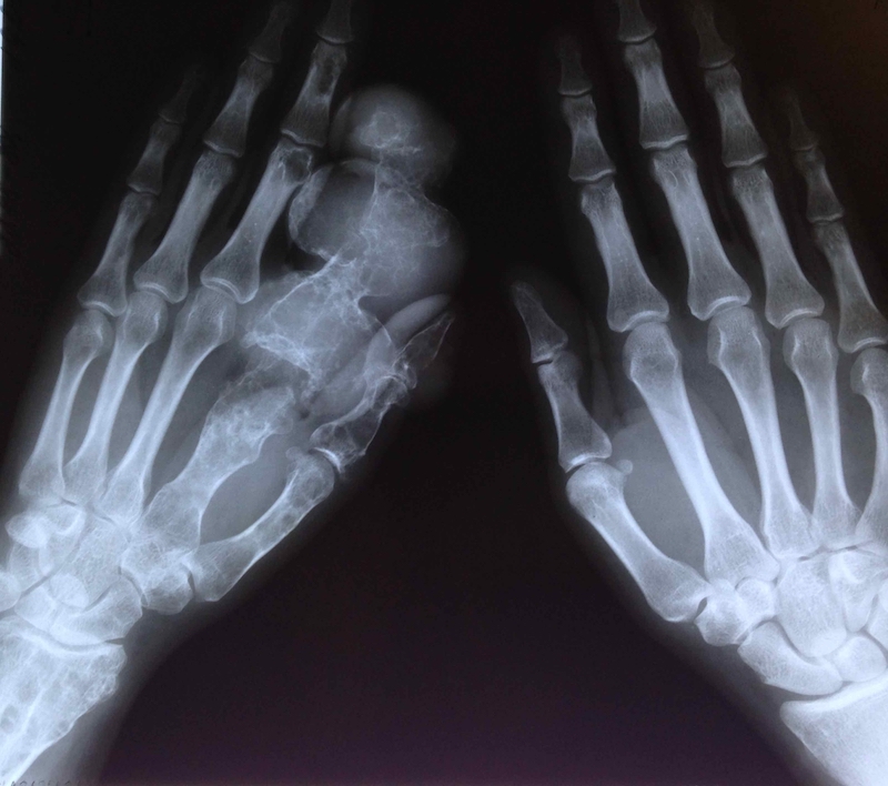 X-ray of Chondrosarcoma in the hand. 