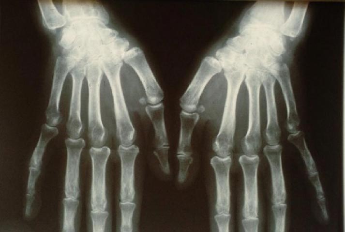 X-ray showing adult-onset Still's disease in hands