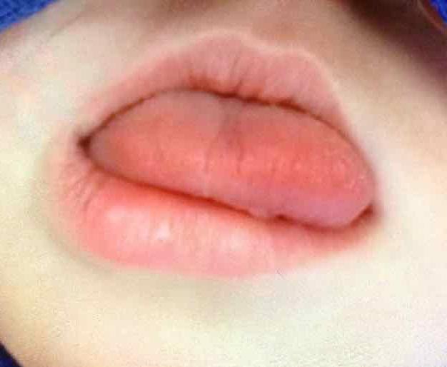 Child with Beckwith-Wiedemann Syndrome (BWS) undergoing tongue reduction surgery. 