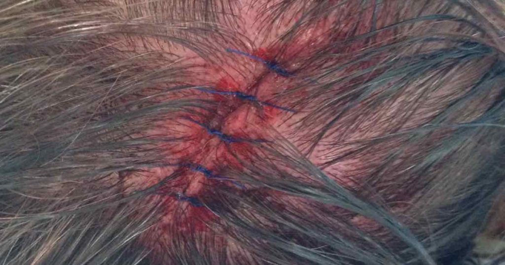 Scalp laceration from a fall