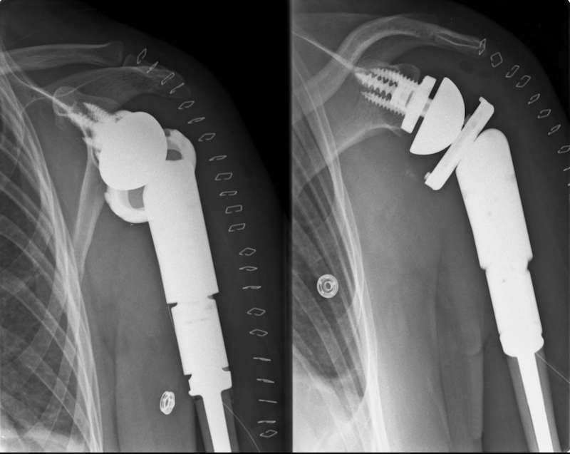 X-ray of shoulder with medullary chondrosarcoma.