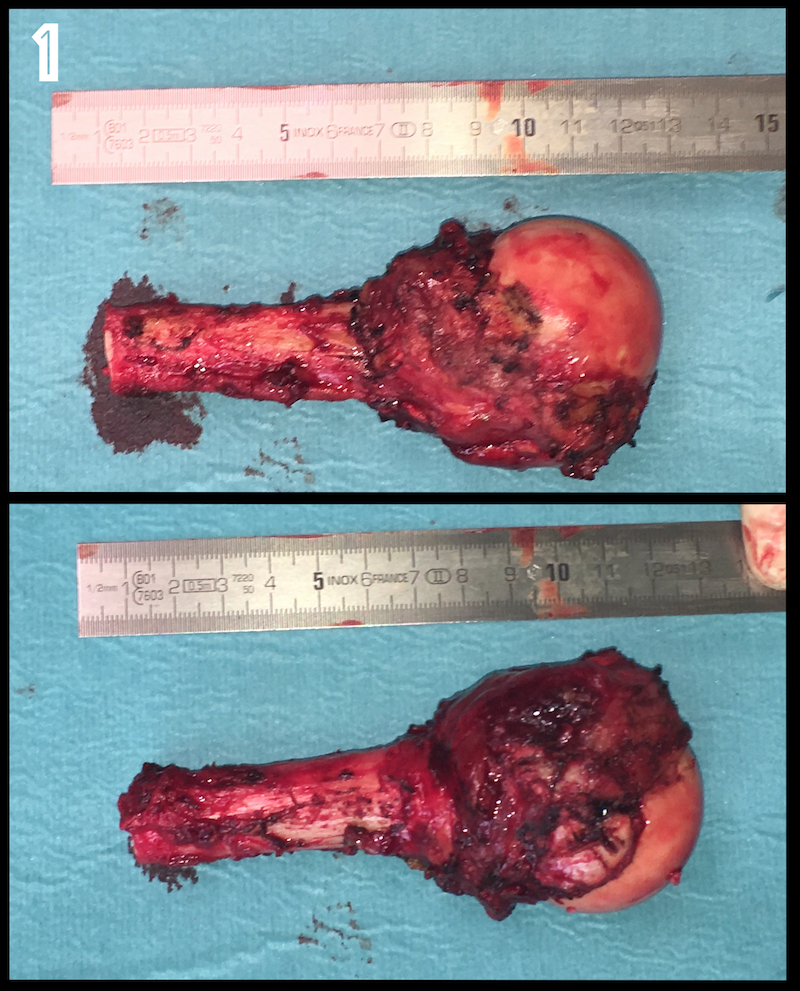 Resected bone from a case of medullary chondrosarcoma