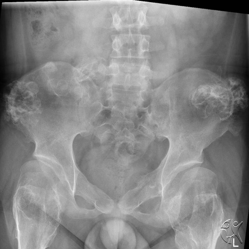 AP X-ray of pelvis showing multiple osteochondromas arising from the pelvis. 
