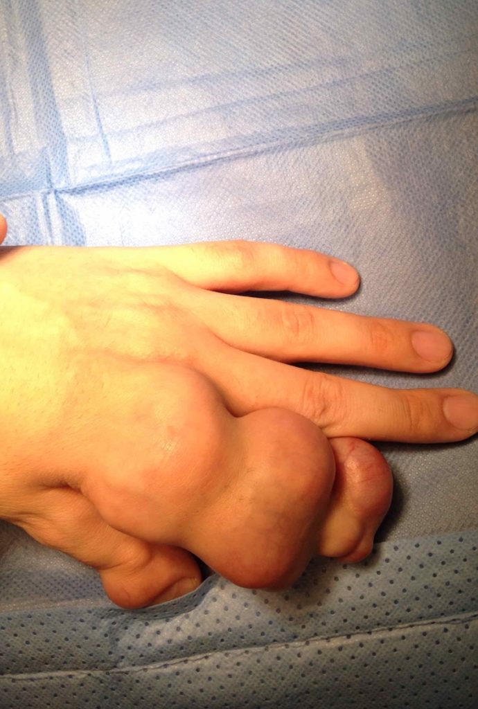 Ollier disease in hand