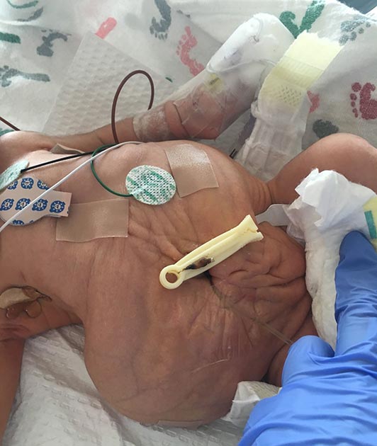 Male infant with prune belly syndrome.