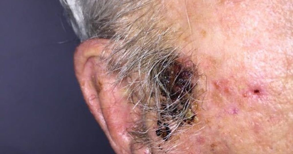 Suspected melanoma next to ear on patient 