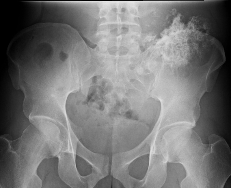 X-ray of chondrosarcoma arising from the iliac bone. 