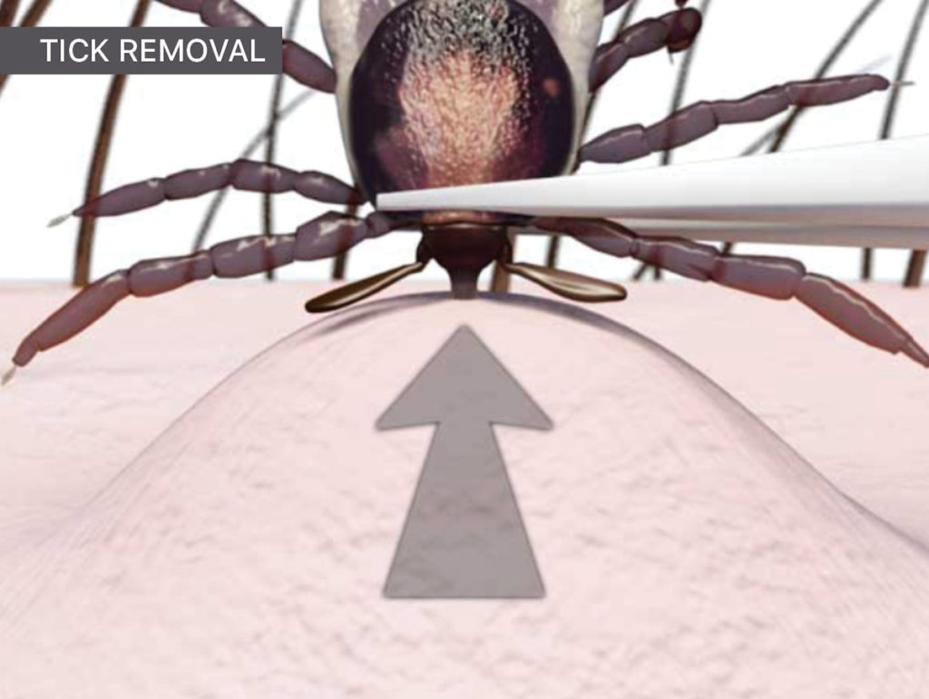How to remove a tick from the skin