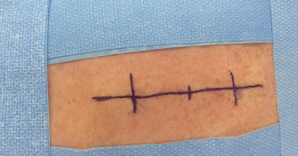 Skin before surgical incision