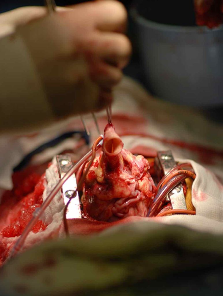 A pediatric heart transplant.