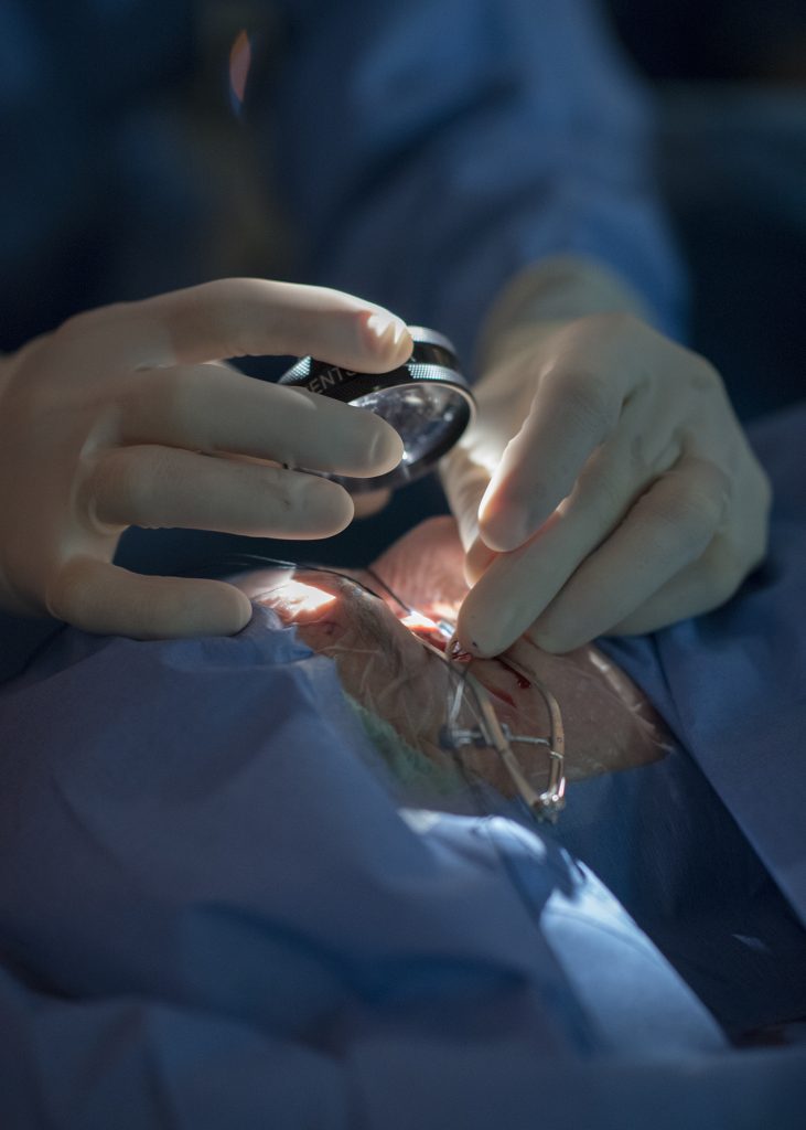 Dr. George Magrath placing a plaque as part of the treatment for a choridal melanoma.