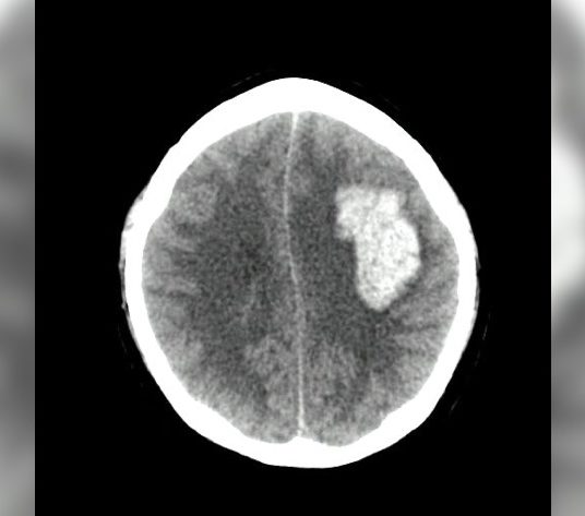 Intracerebral Hemorrhage Score for Patient with Headache, Confusion and History of Drug Use