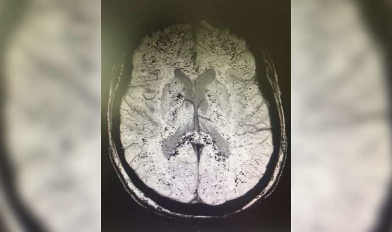 Brain MRI showing multiple ECMO associated cerebral microbleeds.