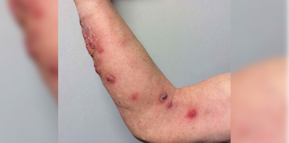 Sporotrichosis on the arm of a 42-year-old man.  