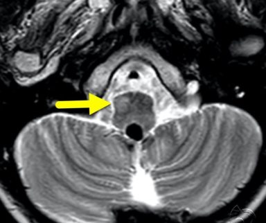 Hypertrophic olivary degeneration