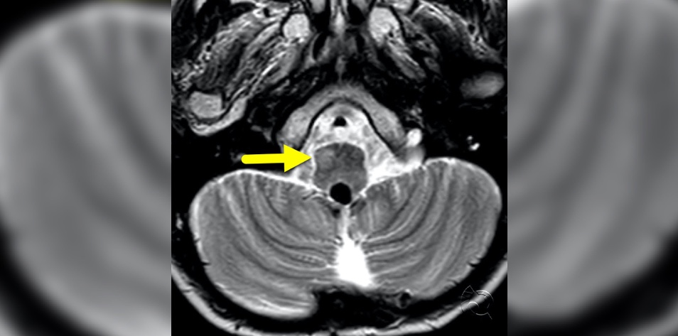 Hypertrophic olivary degeneration