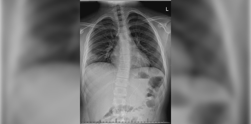 Intermittent chest pain and dyspnea