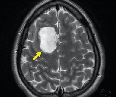 Asymptomatic Intracranial Epidermoid Cyst