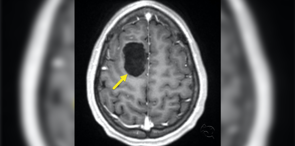 Asymptomatic Intracranial Epidermoid Cyst