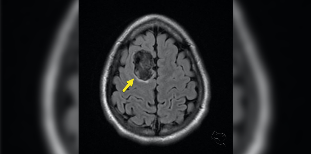 Asymptomatic Intracranial Epidermoid Cyst