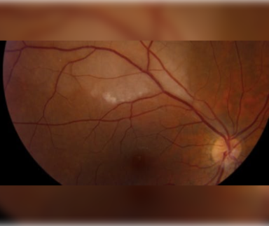 Branch retinal artery occlusion