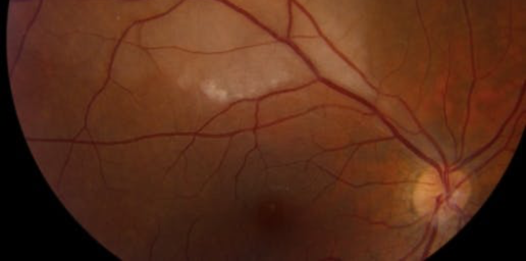 Branch retinal artery occlusion