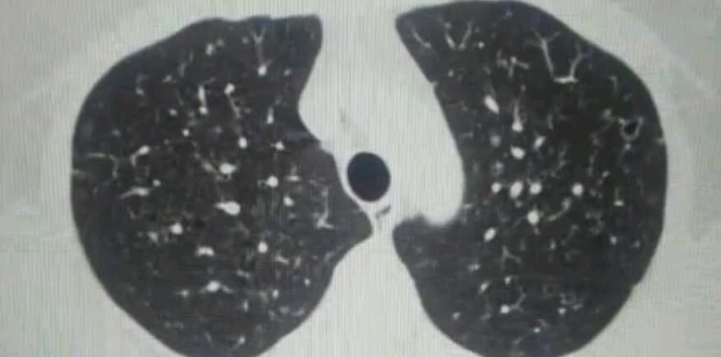 dyspnea medical treatment