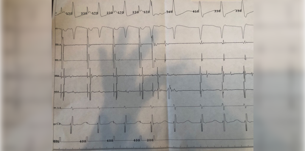 abnormal ecg report