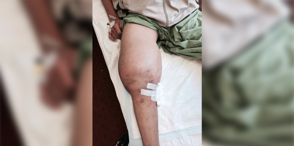 How Would You Initially Manage This Patient With Hemophilia A?