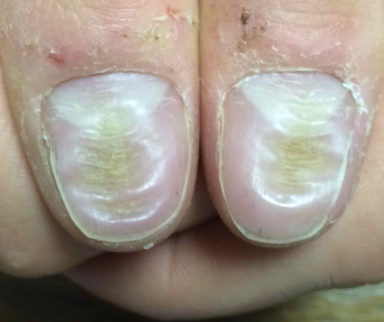 Median Nail Dystrophy and Habit-Tic Deformity