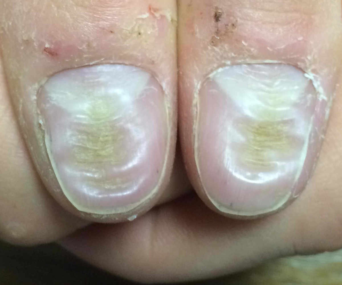 Median Nail Dystrophy and HabitTic Deformity Figure 1