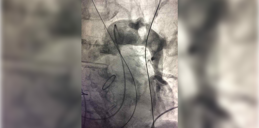 diagnosis pulmonary embolism