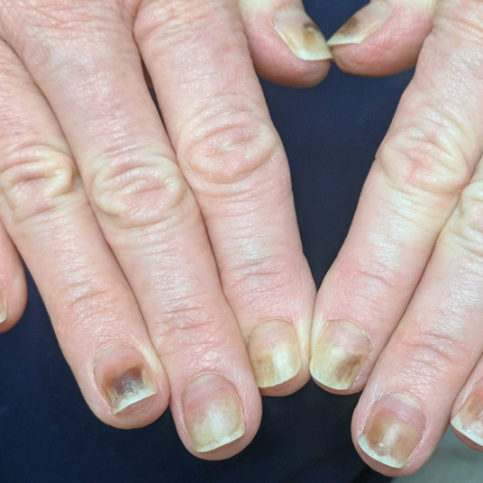 What Most Likely Accounts for This Patient’s Nail Discoloration and Distal Onycholysis?