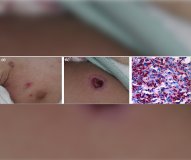 What's the Best Treatment for this Infants Severe Combined Immunodeficiency?
