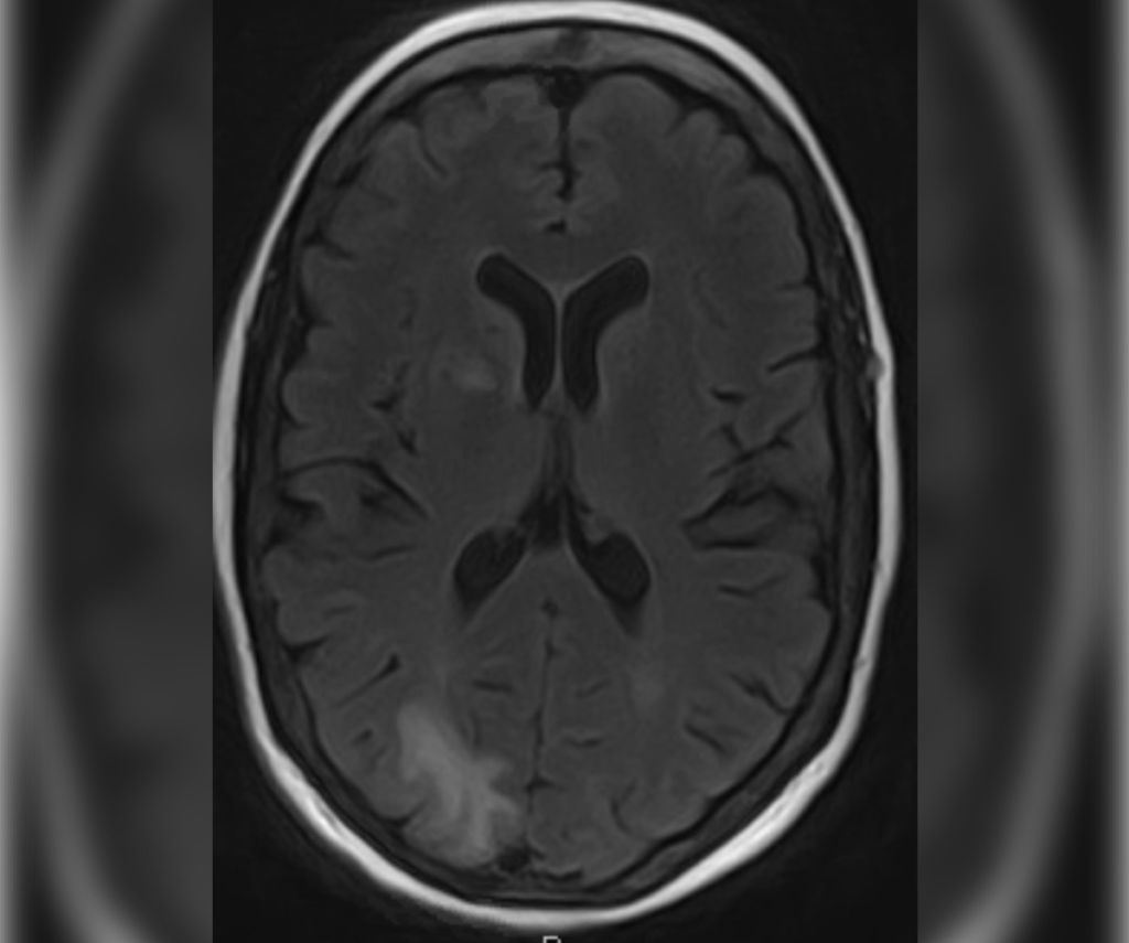 Progressive multifocal leukoencephalopathy in patient with HIV