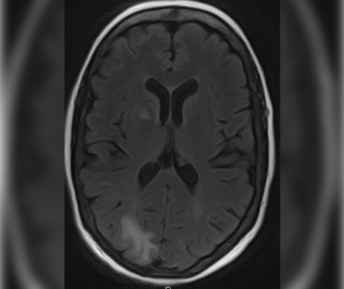 Progressive multifocal leukoencephalopathy in patient with HIV