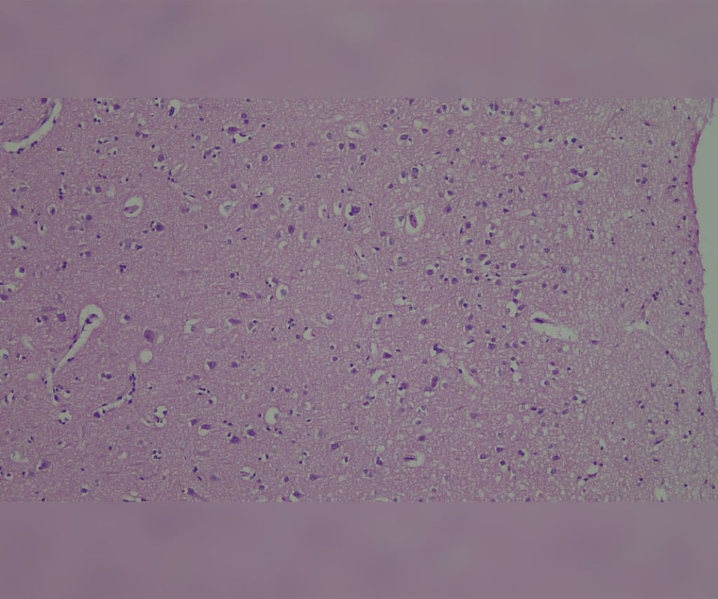 Progressive multifocal leukoencephalopathy in patient with HIV