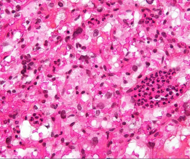 Von Hippel Lindau Disease