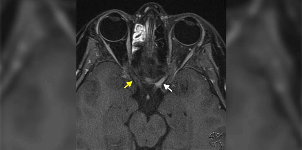 Multiple Sclerosis medical case