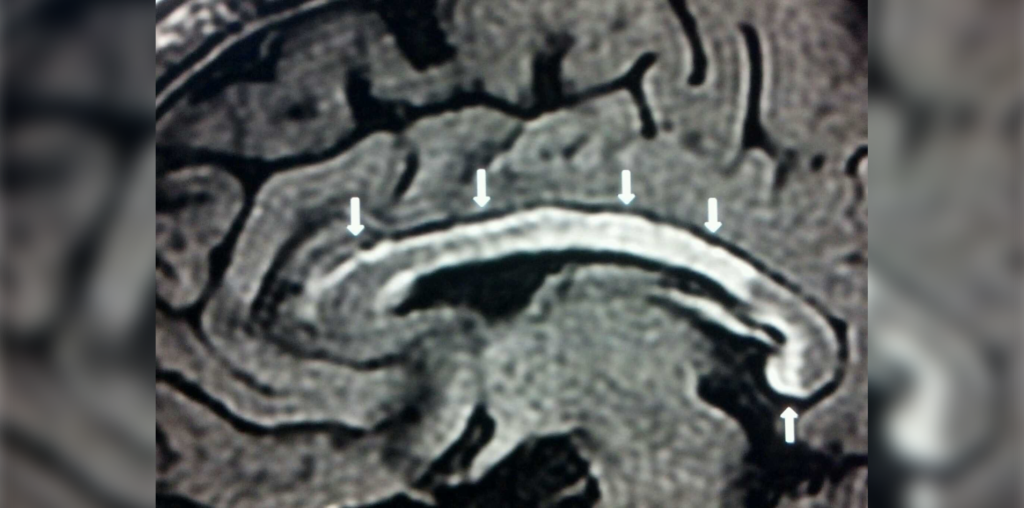 Multiple Sclerosis diagnosis