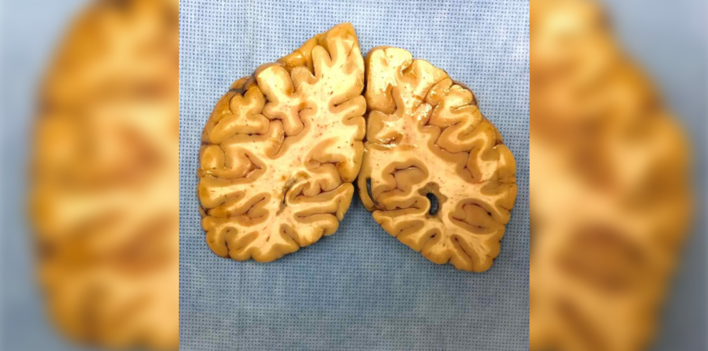 Multiple Sclerosis disease