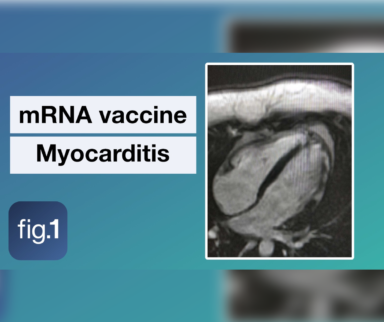 Myocarditis and COVID-19 mRNA Vaccines