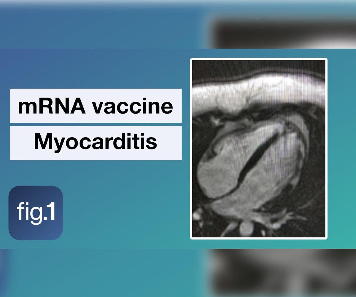 Myocarditis and covid 19 mrna vaccines figure 1