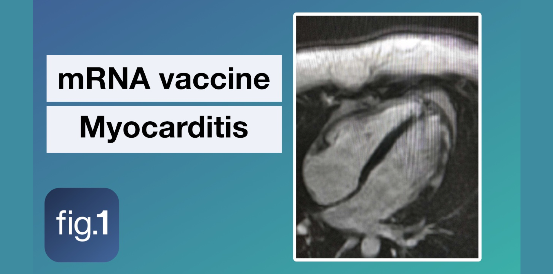 Myocarditis and covid 19 mrna vaccines figure 1