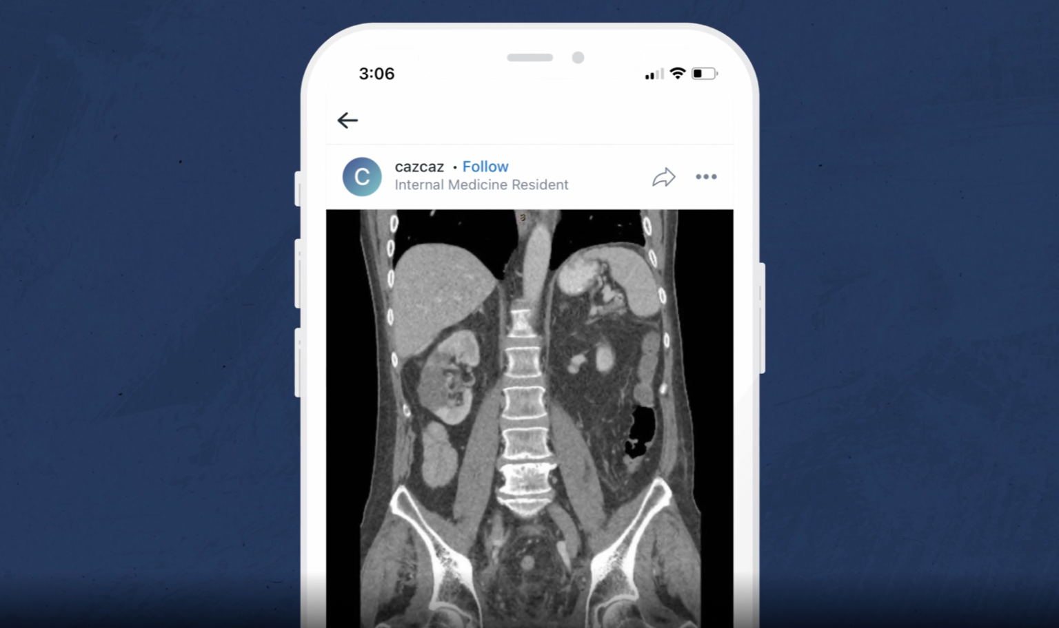 Does Radiation Exposure from CT Scans Increase Your Risk of Cancer? Figure 1