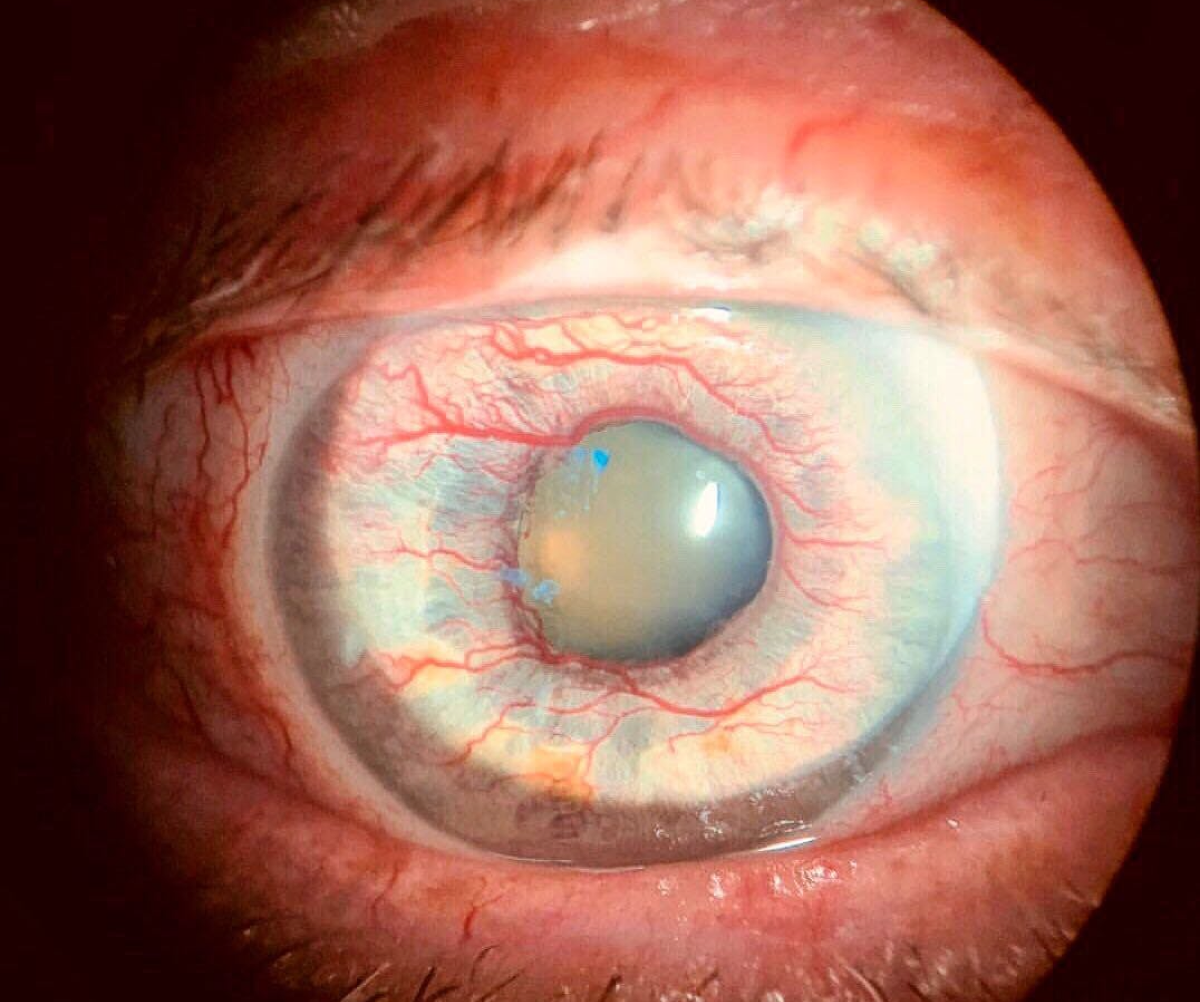 The Shocking Truth About Ophthalmalgia - gk1aarw
